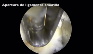 ¿Cómo se Opera una Hernia de Disco?